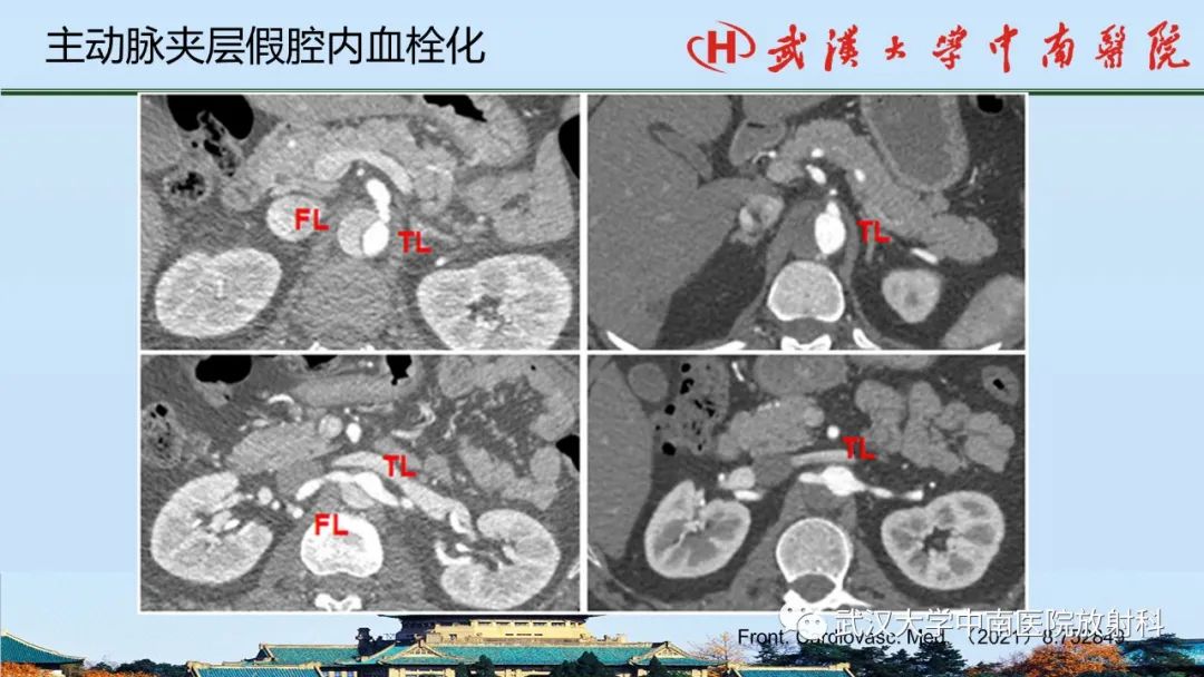 影像PPT - 【PPT】主动脉壁内血肿和穿透性溃疡的影像学诊断-45
