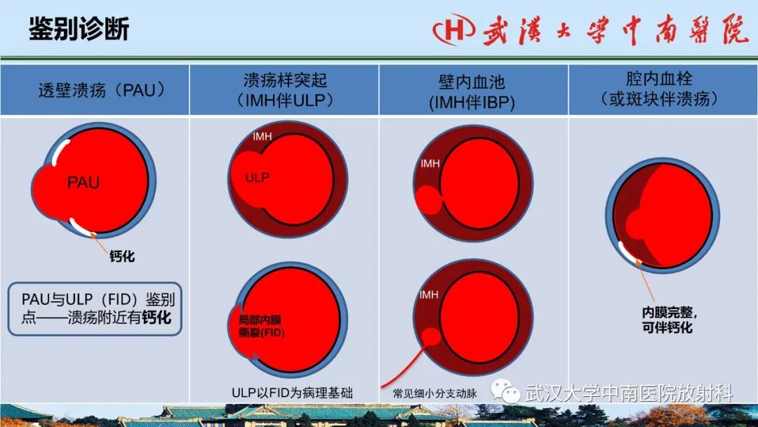 影像PPT - 【PPT】主动脉壁内血肿和穿透性溃疡的影像学诊断-46