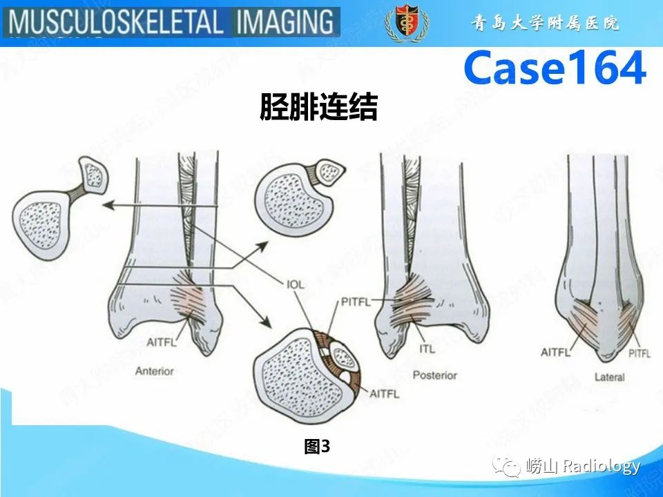 影像PPT - 【PPT】胫腓连结断裂-6