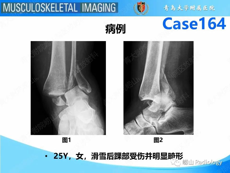 影像PPT - 【PPT】胫腓连结断裂-2