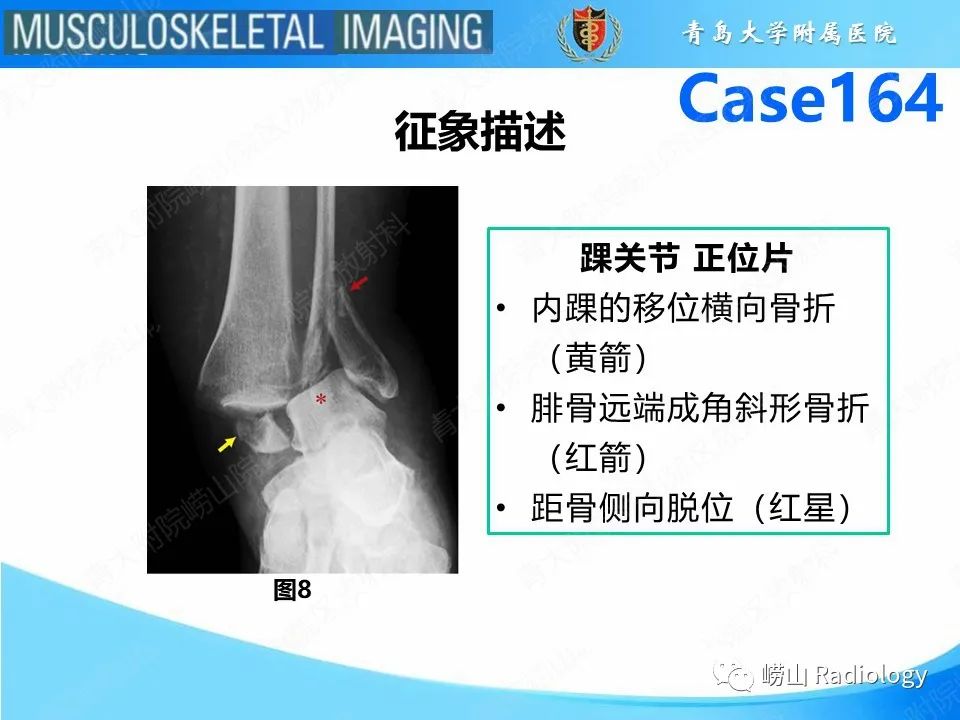 影像PPT - 【PPT】胫腓连结断裂-18
