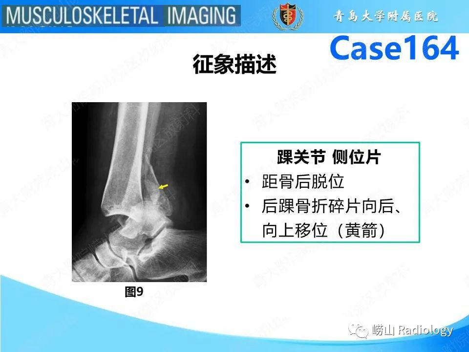 影像PPT - 【PPT】胫腓连结断裂-19