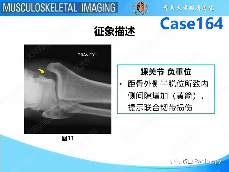 影像PPT - 【PPT】胫腓连结断裂-21