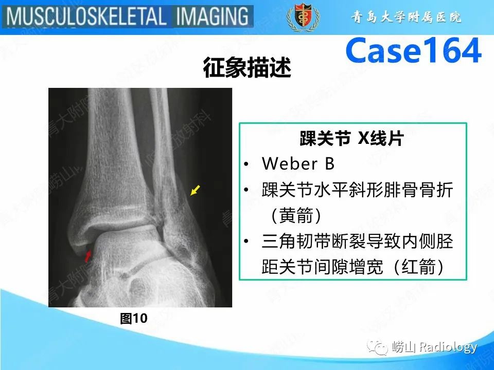 影像PPT - 【PPT】胫腓连结断裂-20