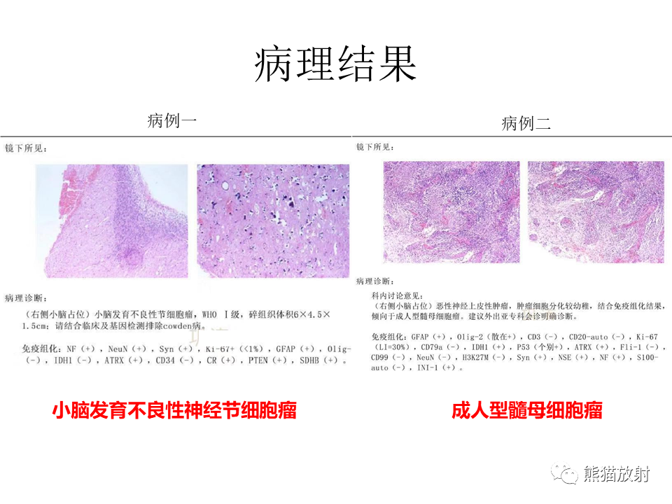 影像PPT - 【PPT】小脑发育不良性神经节细胞瘤 VS 成人型髓母细胞瘤-28