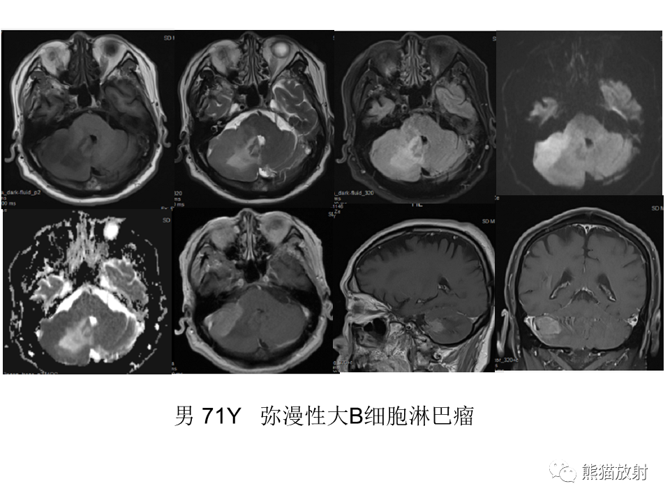 影像PPT - 【PPT】小脑发育不良性神经节细胞瘤 VS 成人型髓母细胞瘤-43