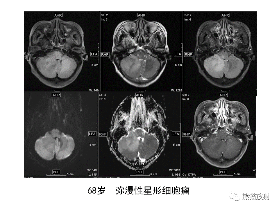 影像PPT - 【PPT】小脑发育不良性神经节细胞瘤 VS 成人型髓母细胞瘤-39