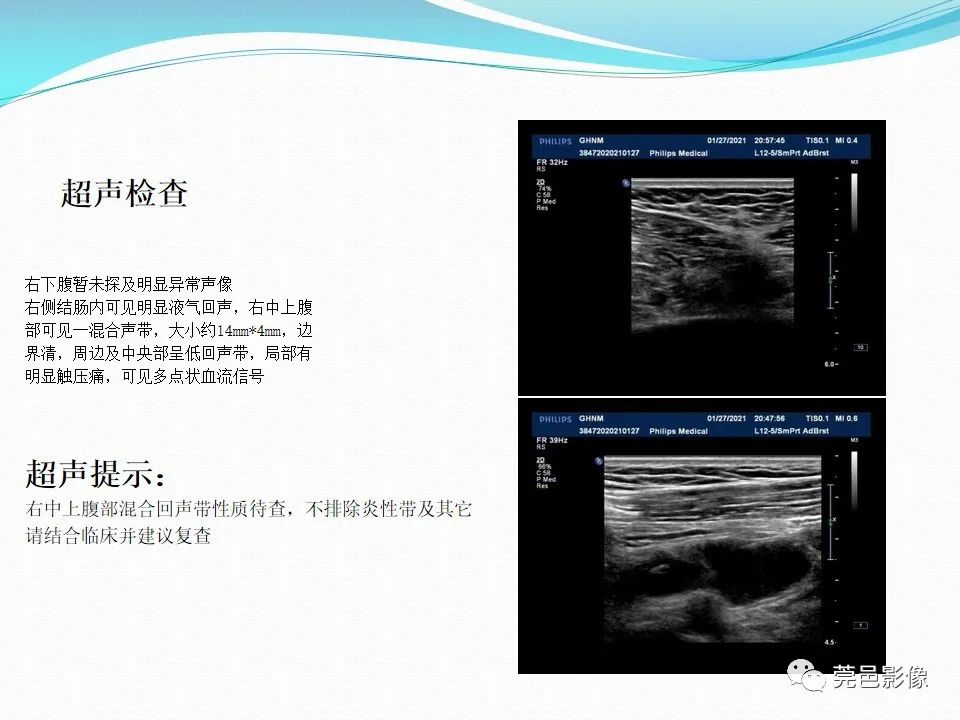 影像PPT - 【PPT】大网膜梗死的CT诊断-5