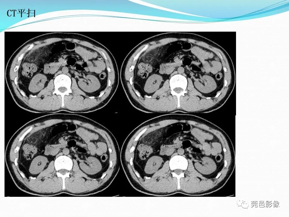 影像PPT - 【PPT】大网膜梗死的CT诊断-6