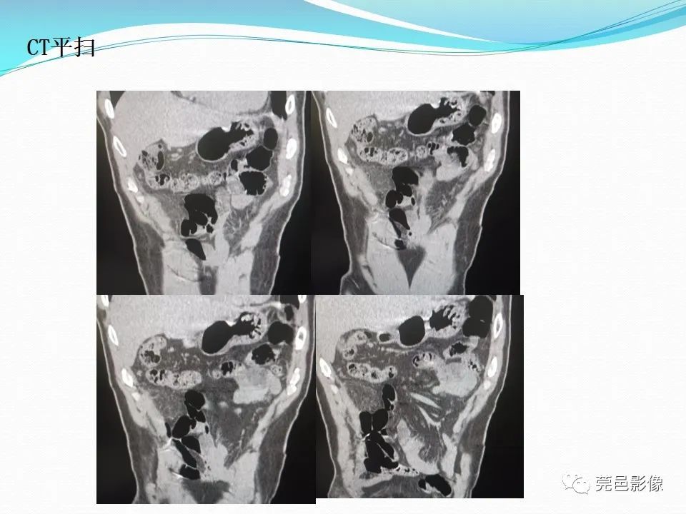影像PPT - 【PPT】大网膜梗死的CT诊断-12