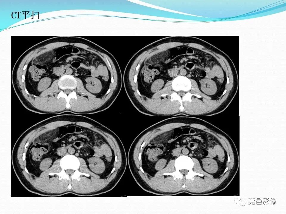 影像PPT - 【PPT】大网膜梗死的CT诊断-9