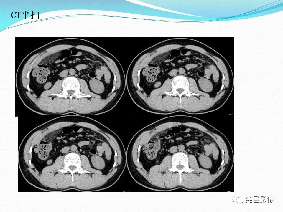 影像PPT - 【PPT】大网膜梗死的CT诊断-11