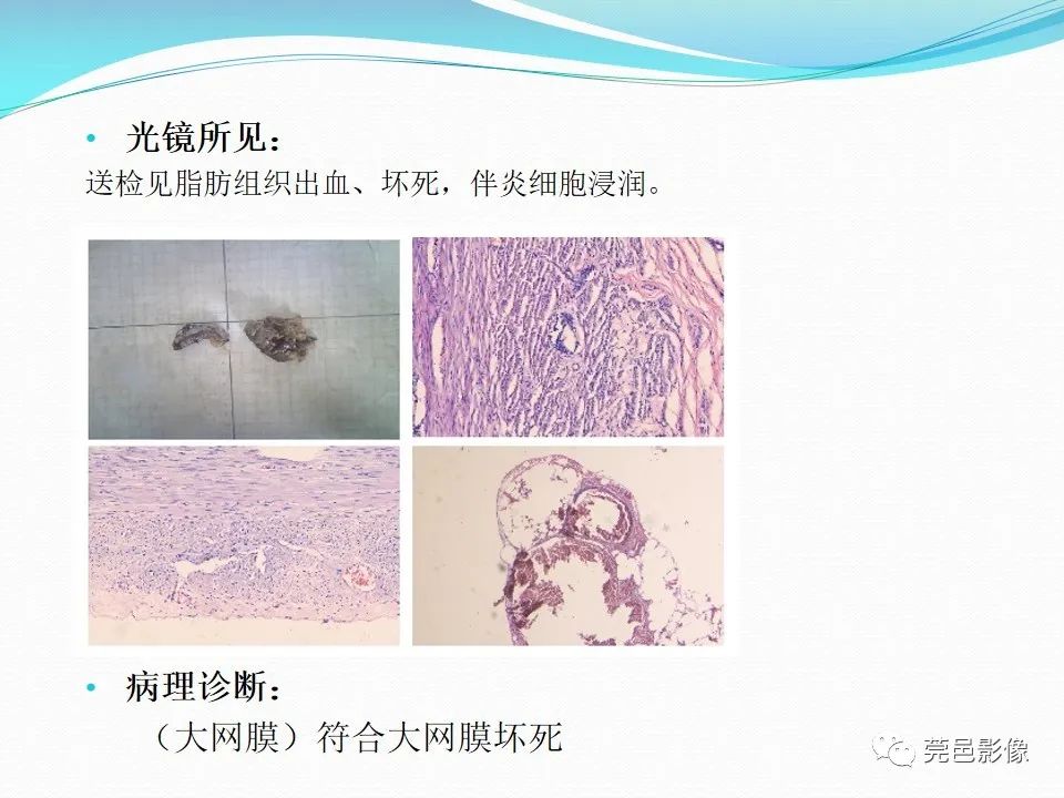 影像PPT - 【PPT】大网膜梗死的CT诊断-17