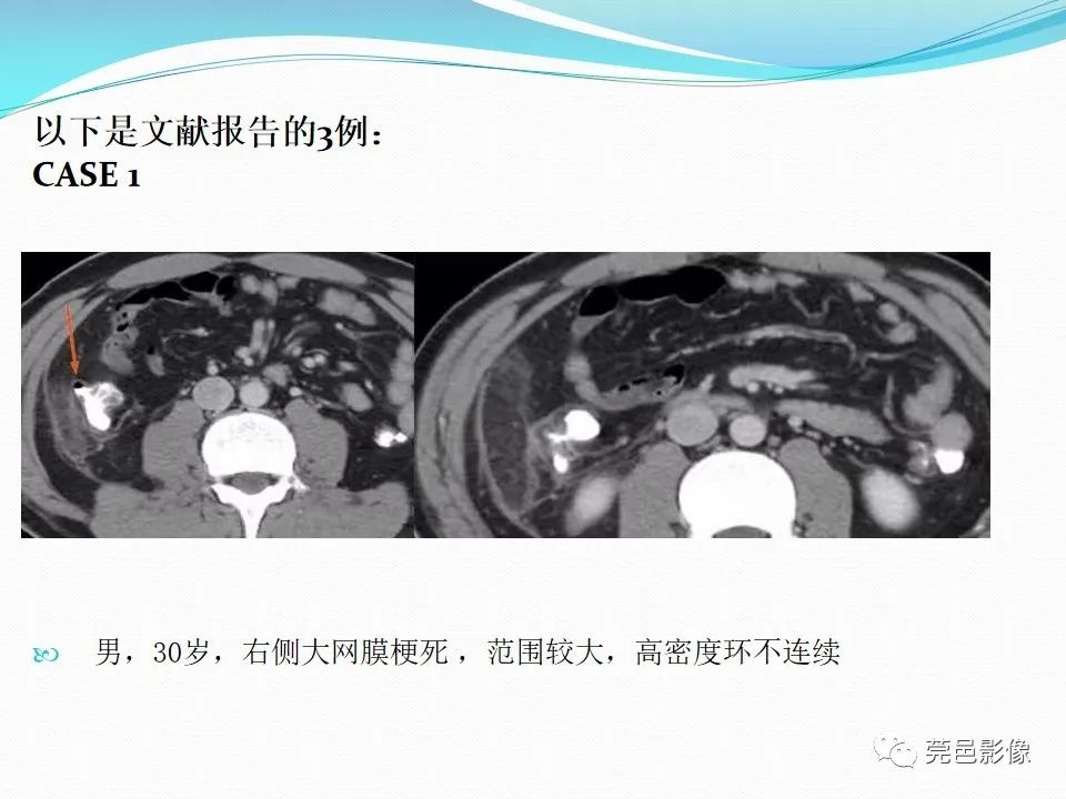影像PPT - 【PPT】大网膜梗死的CT诊断-23