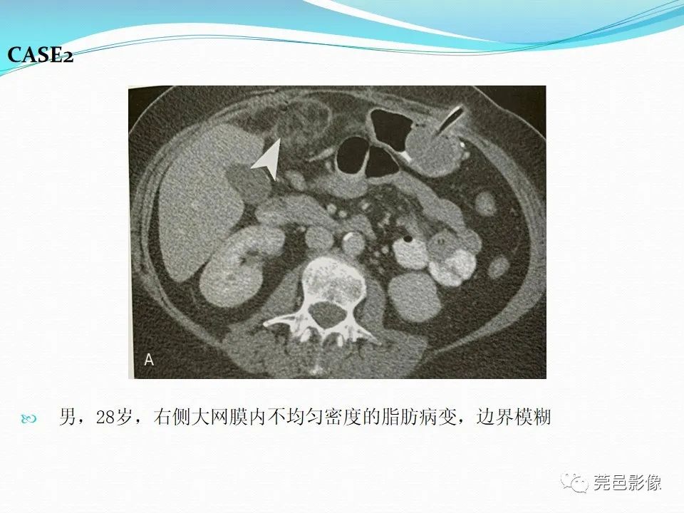 影像PPT - 【PPT】大网膜梗死的CT诊断-24