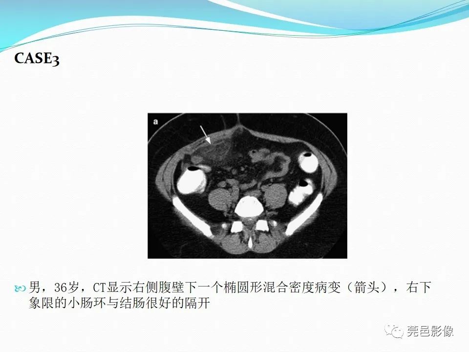 影像PPT - 【PPT】大网膜梗死的CT诊断-25