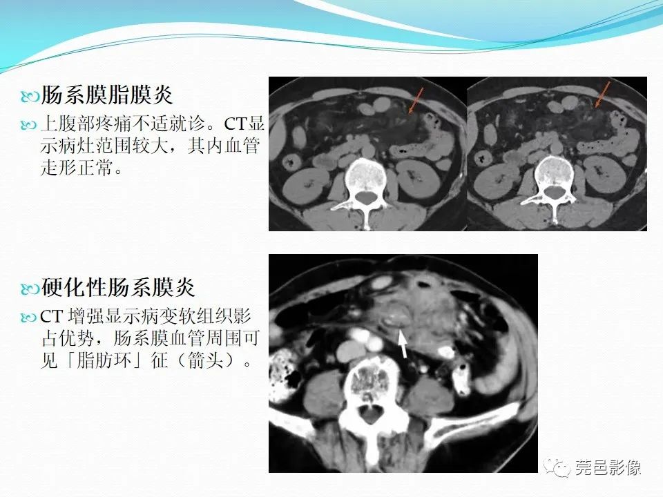 影像PPT - 【PPT】大网膜梗死的CT诊断-29