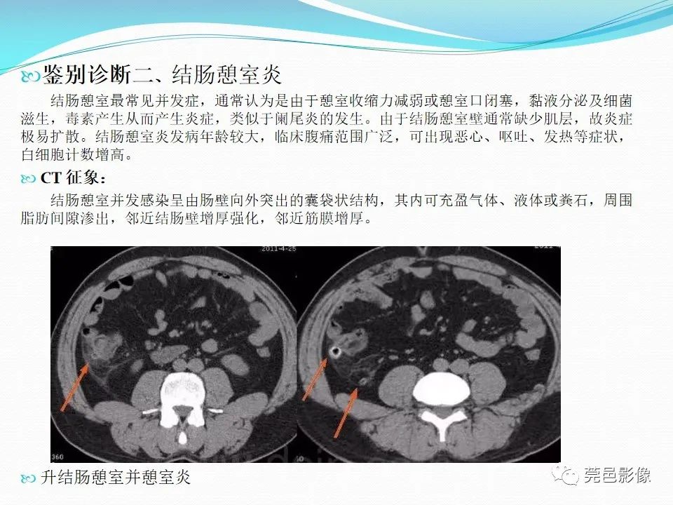 影像PPT - 【PPT】大网膜梗死的CT诊断-27