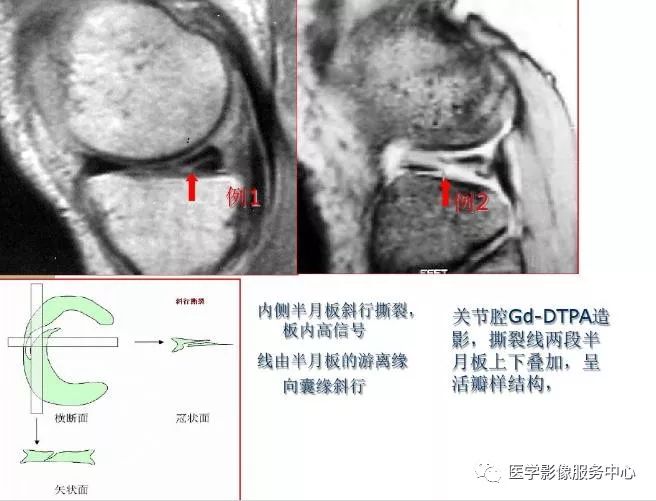 影像PPT - 膝关节损伤的MRI表现-3 影像PPT - 膝关节损伤的MRI表现-3