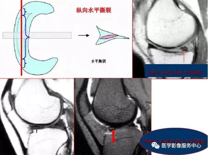 影像PPT - 膝关节损伤的MRI表现-4 影像PPT - 膝关节损伤的MRI表现-4
