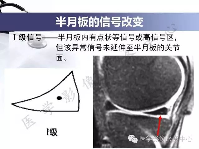 影像PPT - 膝关节损伤的MRI表现-2 影像PPT - 膝关节损伤的MRI表现-2