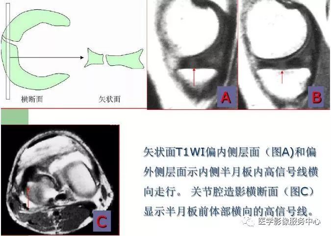影像PPT - 膝关节损伤的MRI表现-7 影像PPT - 膝关节损伤的MRI表现-7