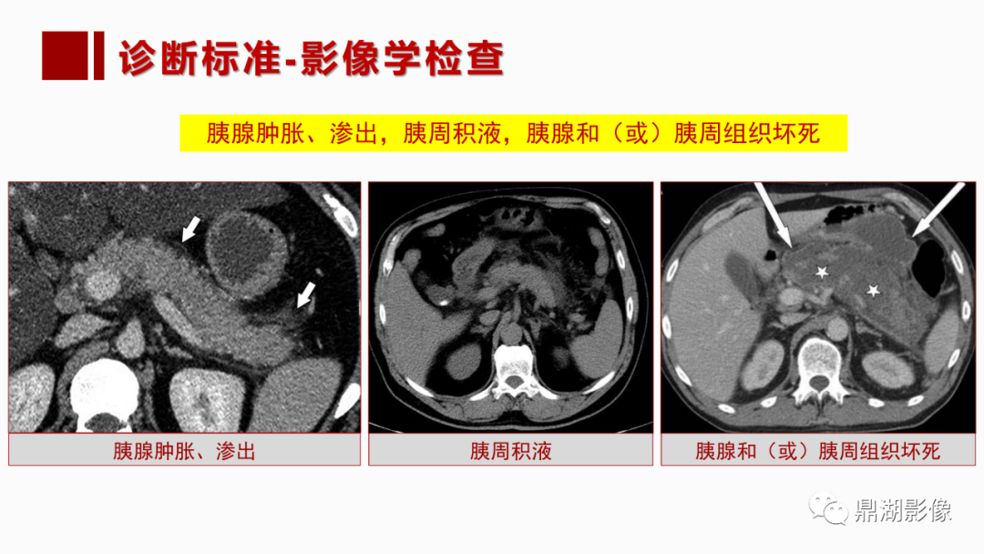 影像PPT - 【PPT】基于修订版亚特兰大急性胰腺炎分类的诊断、临床影像评估及治疗-12