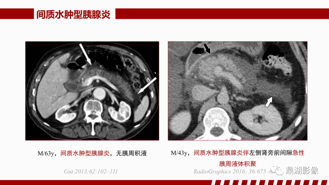 影像PPT - 【PPT】基于修订版亚特兰大急性胰腺炎分类的诊断、临床影像评估及治疗-23