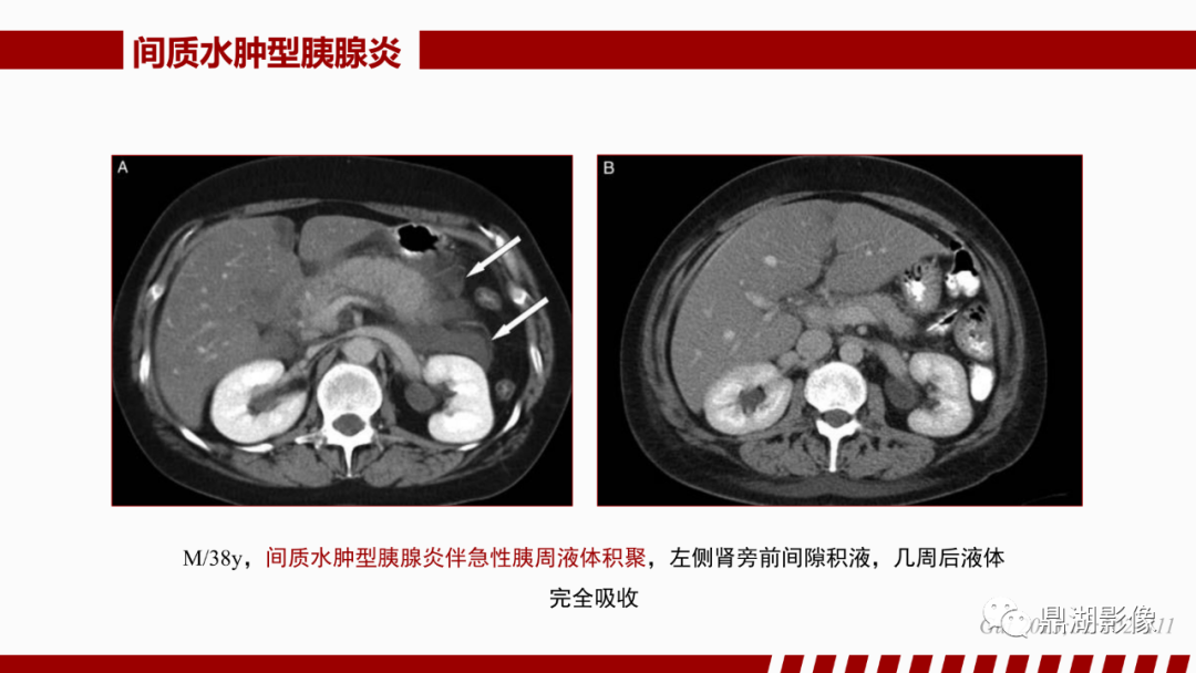影像PPT - 【PPT】基于修订版亚特兰大急性胰腺炎分类的诊断、临床影像评估及治疗-24