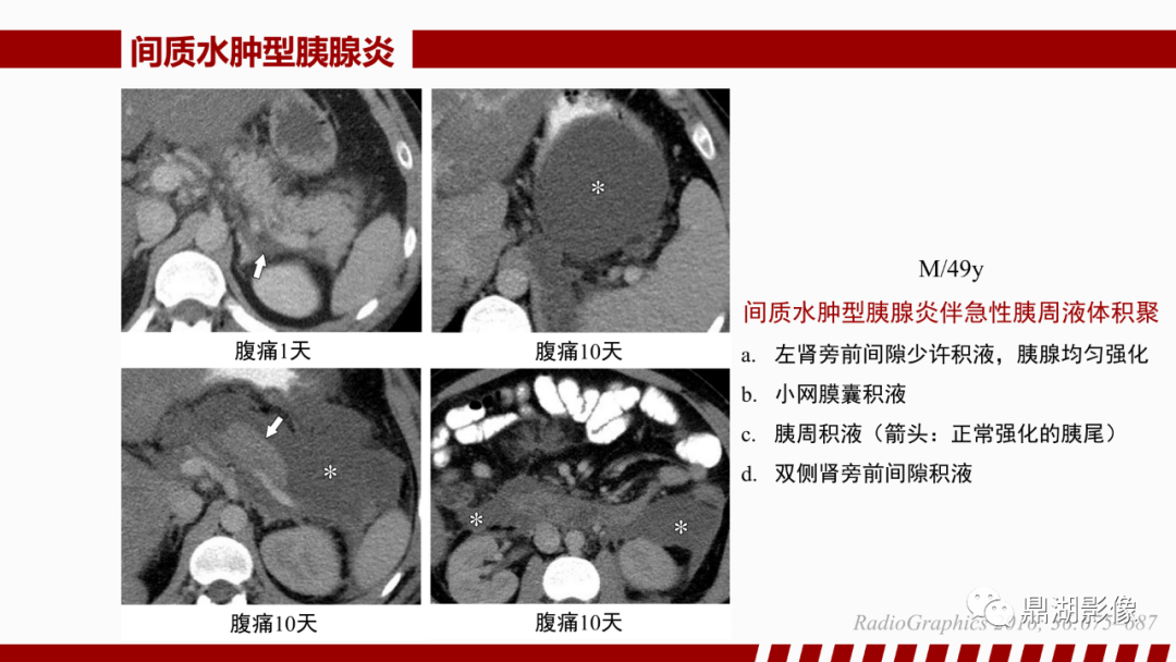 影像PPT - 【PPT】基于修订版亚特兰大急性胰腺炎分类的诊断、临床影像评估及治疗-25