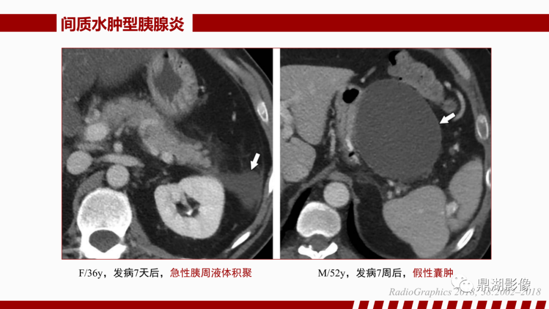 影像PPT - 【PPT】基于修订版亚特兰大急性胰腺炎分类的诊断、临床影像评估及治疗-26