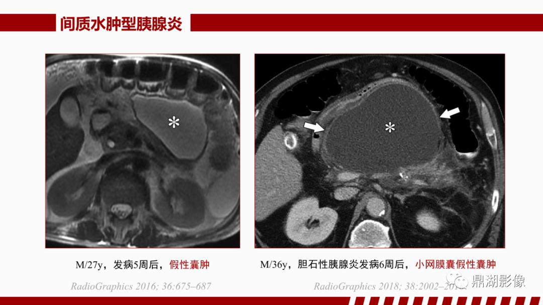 影像PPT - 【PPT】基于修订版亚特兰大急性胰腺炎分类的诊断、临床影像评估及治疗-27
