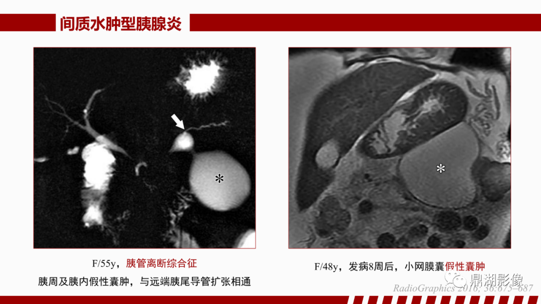 影像PPT - 【PPT】基于修订版亚特兰大急性胰腺炎分类的诊断、临床影像评估及治疗-28