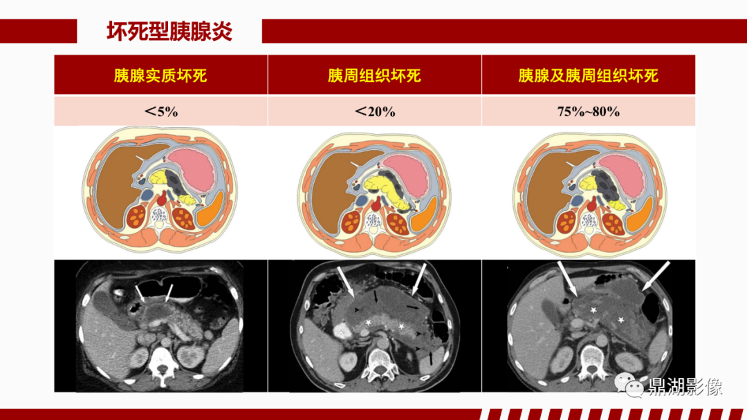 影像PPT - 【PPT】基于修订版亚特兰大急性胰腺炎分类的诊断、临床影像评估及治疗-30