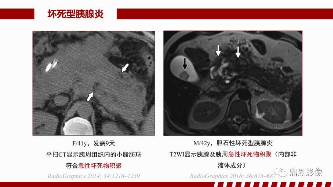 影像PPT - 【PPT】基于修订版亚特兰大急性胰腺炎分类的诊断、临床影像评估及治疗-31
