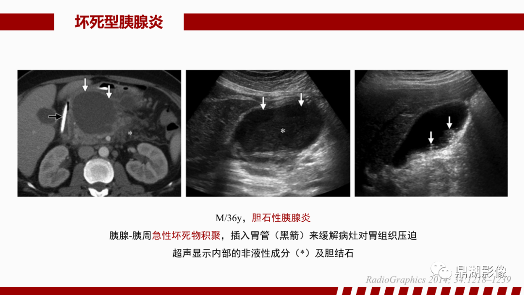 影像PPT - 【PPT】基于修订版亚特兰大急性胰腺炎分类的诊断、临床影像评估及治疗-33