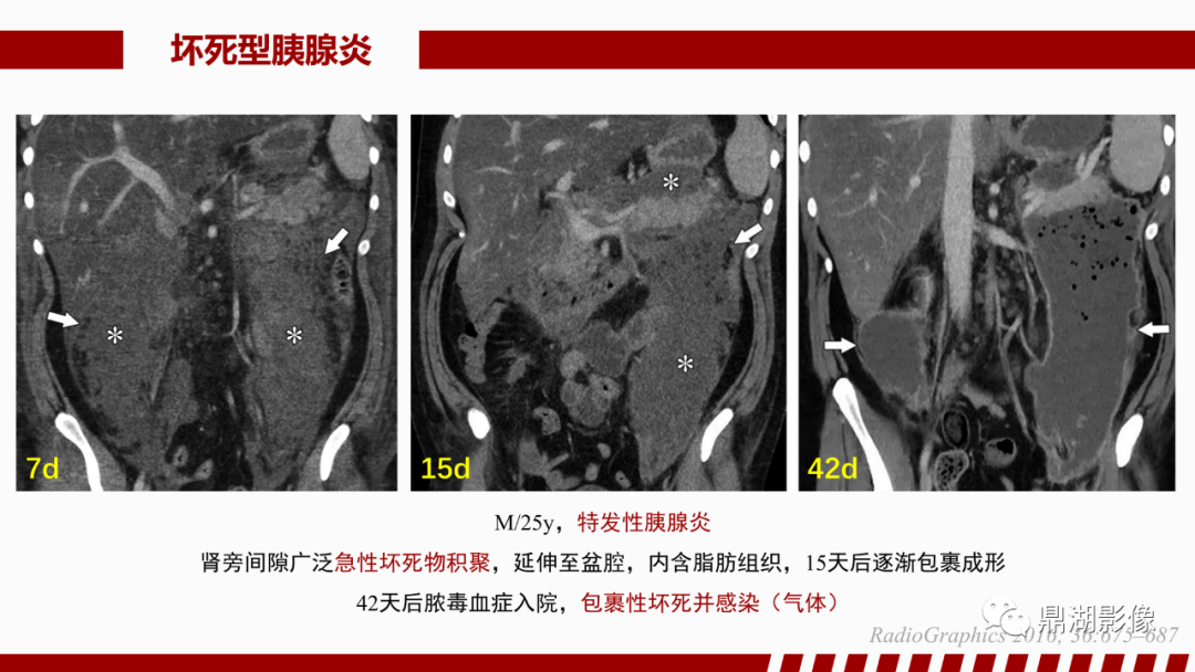 影像PPT - 【PPT】基于修订版亚特兰大急性胰腺炎分类的诊断、临床影像评估及治疗-35