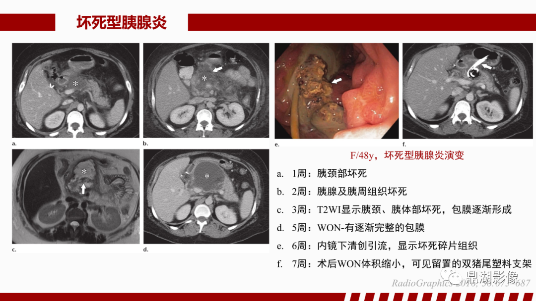影像PPT - 【PPT】基于修订版亚特兰大急性胰腺炎分类的诊断、临床影像评估及治疗-36
