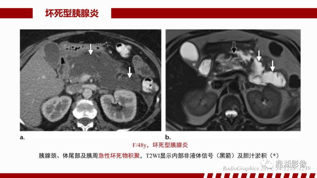 影像PPT - 【PPT】基于修订版亚特兰大急性胰腺炎分类的诊断、临床影像评估及治疗-32