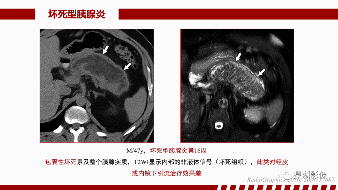 影像PPT - 【PPT】基于修订版亚特兰大急性胰腺炎分类的诊断、临床影像评估及治疗-37