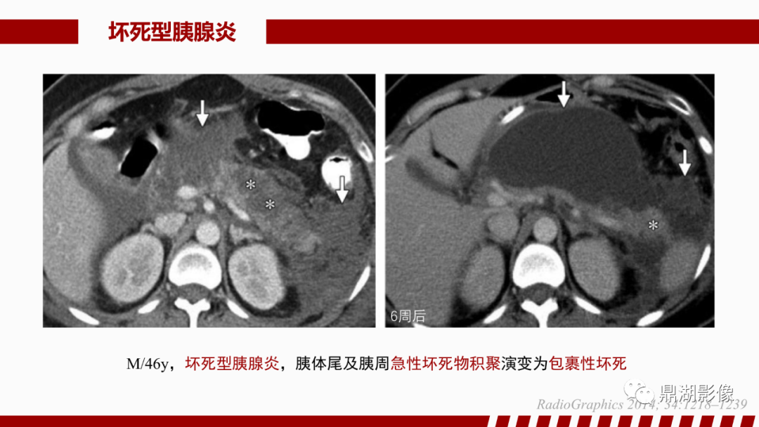 影像PPT - 【PPT】基于修订版亚特兰大急性胰腺炎分类的诊断、临床影像评估及治疗-38