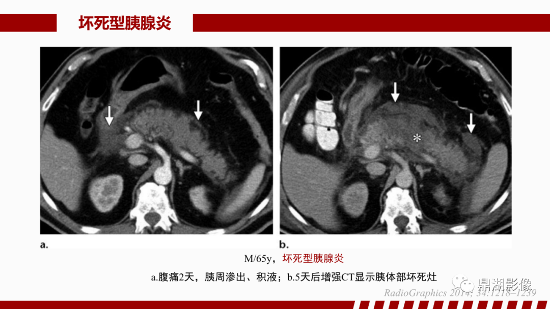 影像PPT - 【PPT】基于修订版亚特兰大急性胰腺炎分类的诊断、临床影像评估及治疗-34