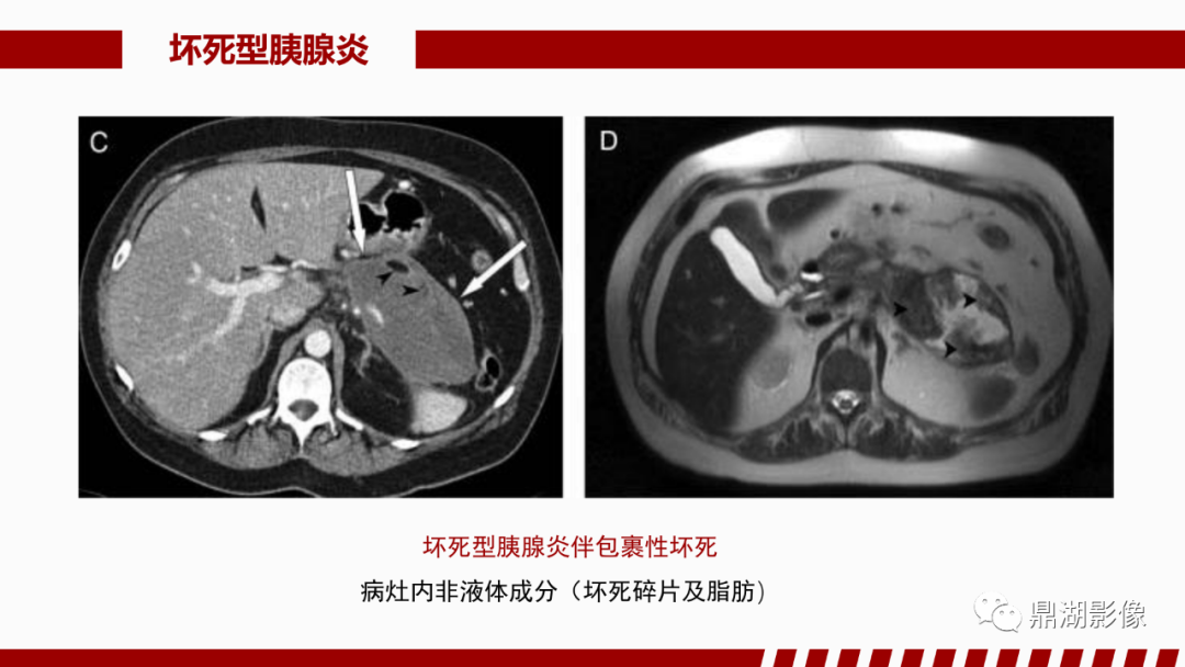 影像PPT - 【PPT】基于修订版亚特兰大急性胰腺炎分类的诊断、临床影像评估及治疗-40