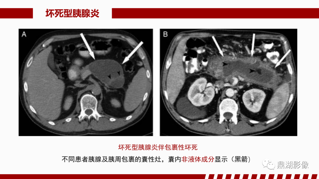 影像PPT - 【PPT】基于修订版亚特兰大急性胰腺炎分类的诊断、临床影像评估及治疗-39