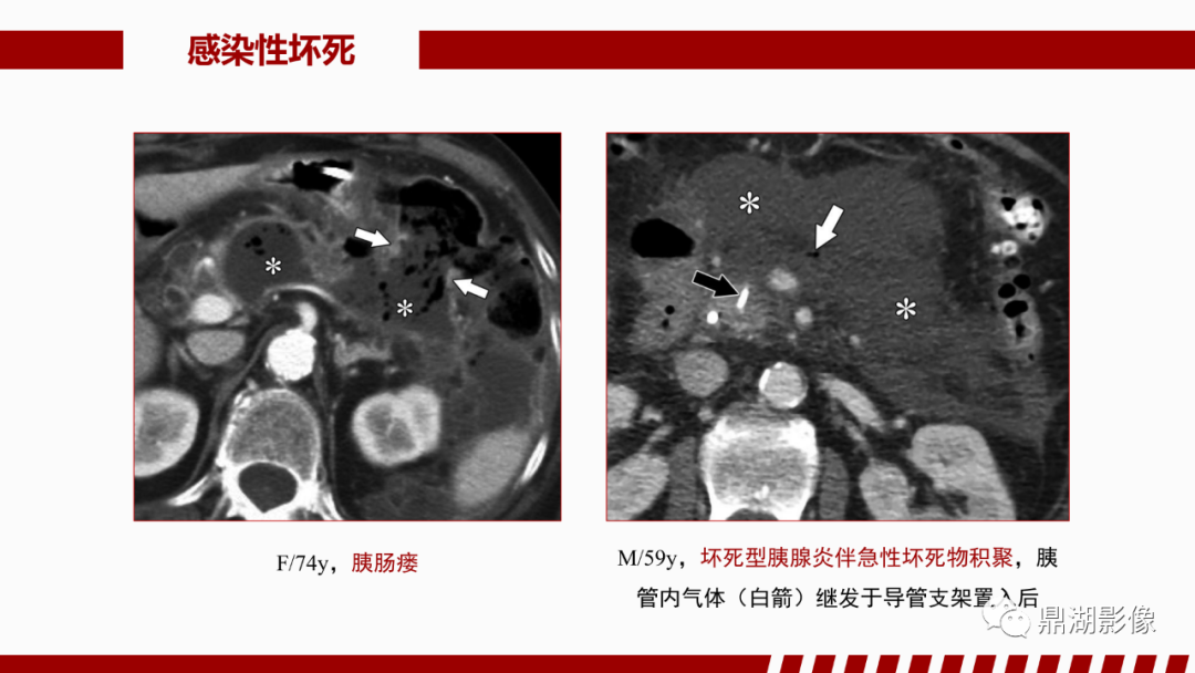 影像PPT - 【PPT】基于修订版亚特兰大急性胰腺炎分类的诊断、临床影像评估及治疗-47