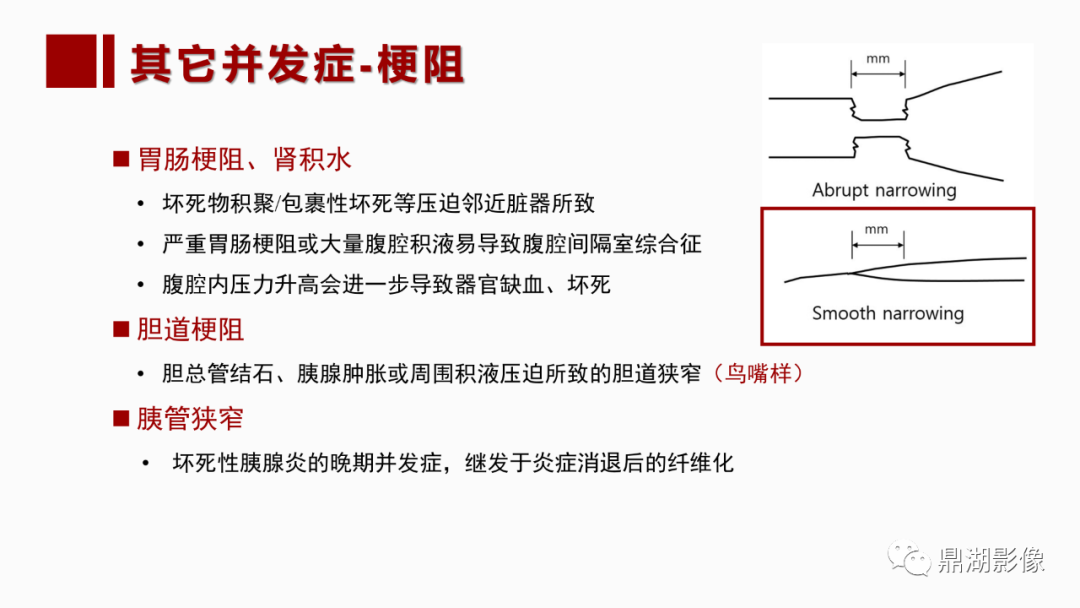 影像PPT - 【PPT】基于修订版亚特兰大急性胰腺炎分类的诊断、临床影像评估及治疗-48