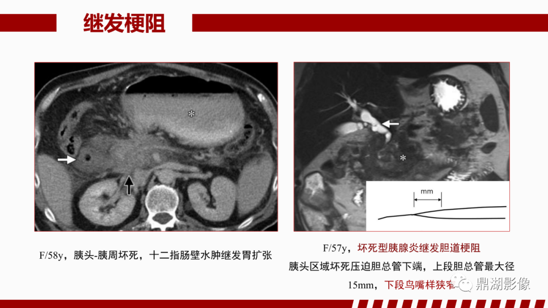影像PPT - 【PPT】基于修订版亚特兰大急性胰腺炎分类的诊断、临床影像评估及治疗-49