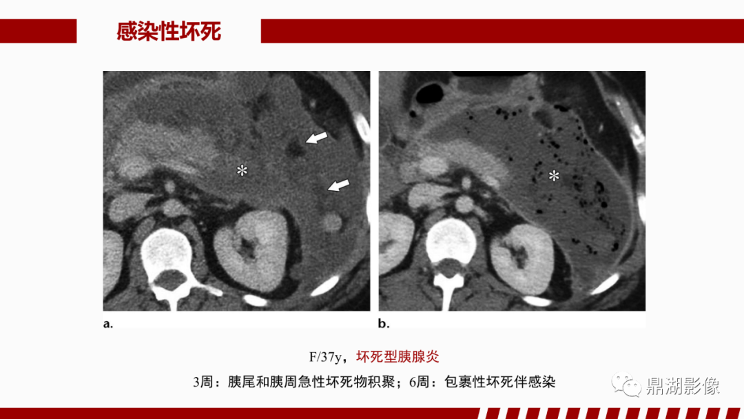 影像PPT - 【PPT】基于修订版亚特兰大急性胰腺炎分类的诊断、临床影像评估及治疗-46