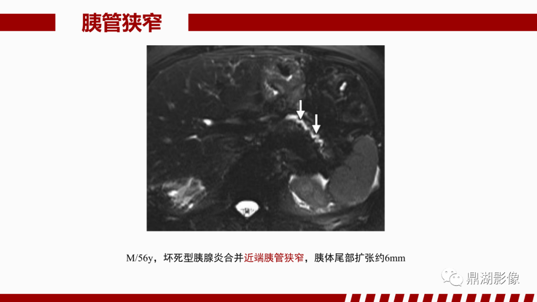 影像PPT - 【PPT】基于修订版亚特兰大急性胰腺炎分类的诊断、临床影像评估及治疗-50