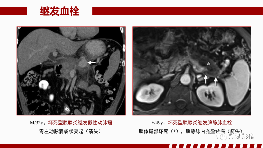 影像PPT - 【PPT】基于修订版亚特兰大急性胰腺炎分类的诊断、临床影像评估及治疗-52